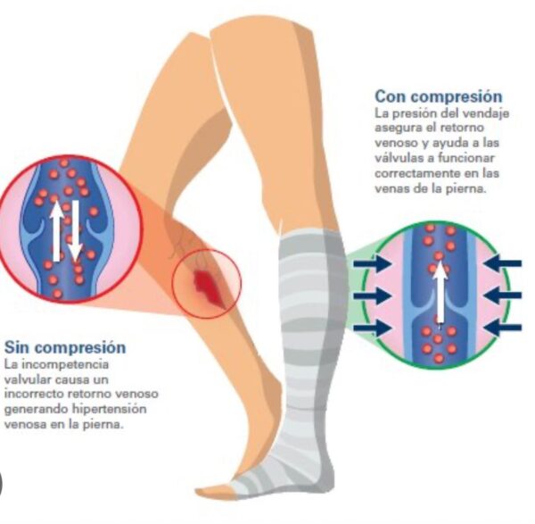 SISTEMA DE COMPRESION DE 2 CAPAS - Imagen 2